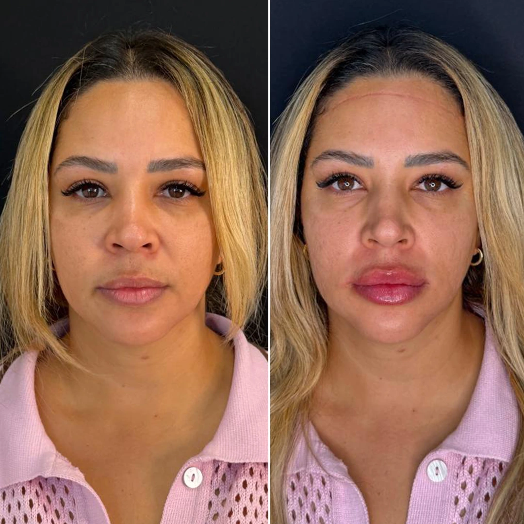 Antes e depois 1 - Dra. Amanda Syuffi