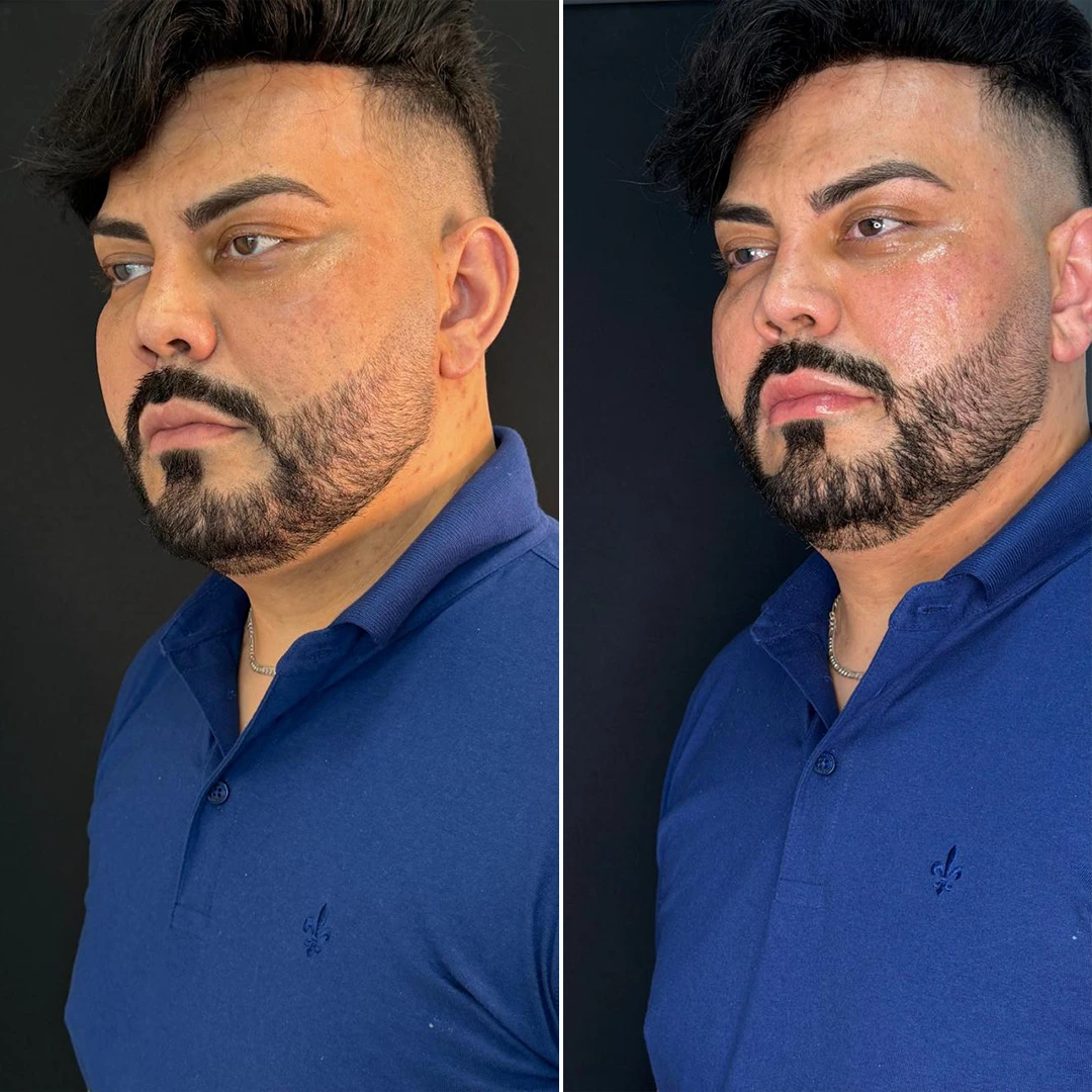 Antes e depois 2 - Dra. Amanda Syuffi