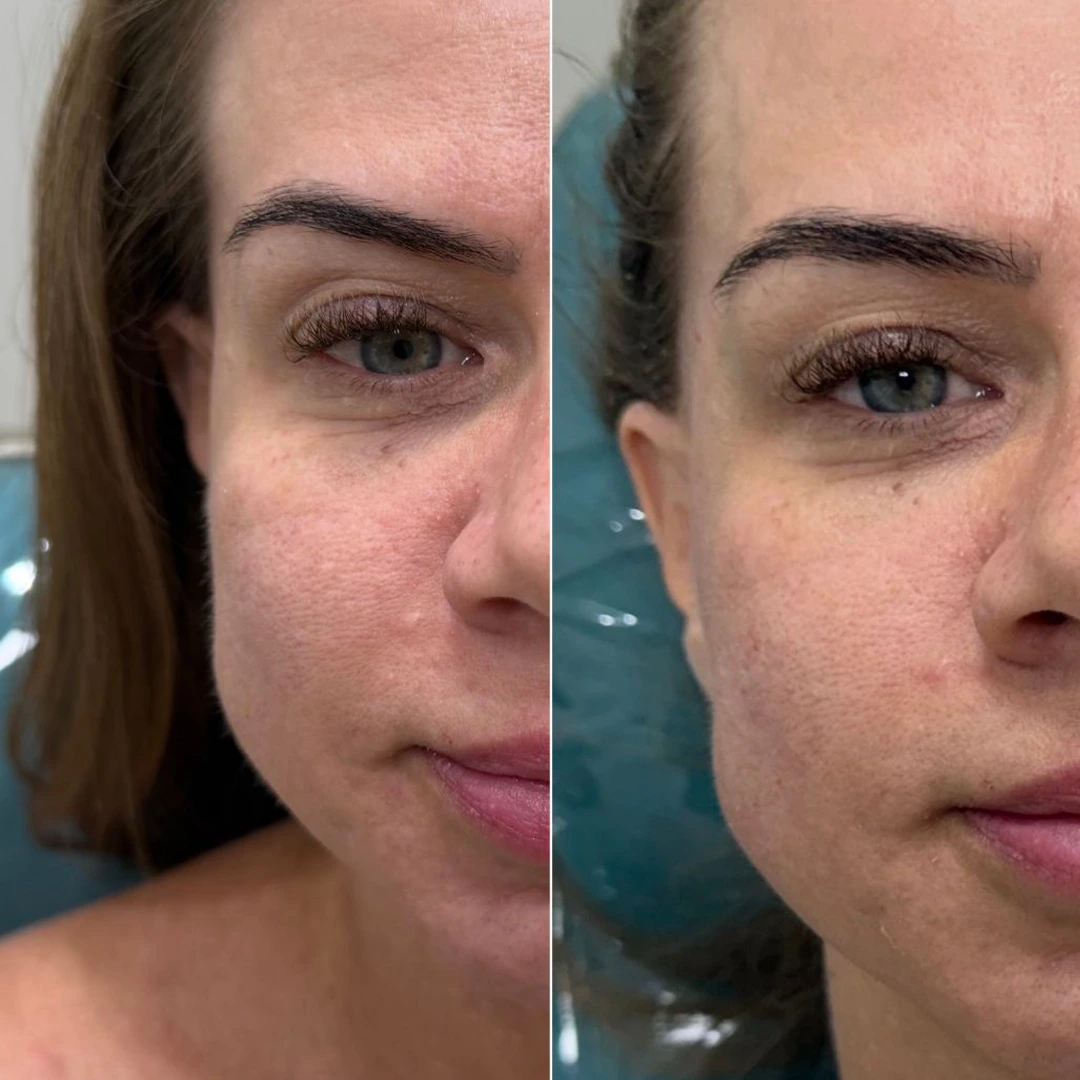 Antes e depois 4 - Dra. Amanda Syuffi