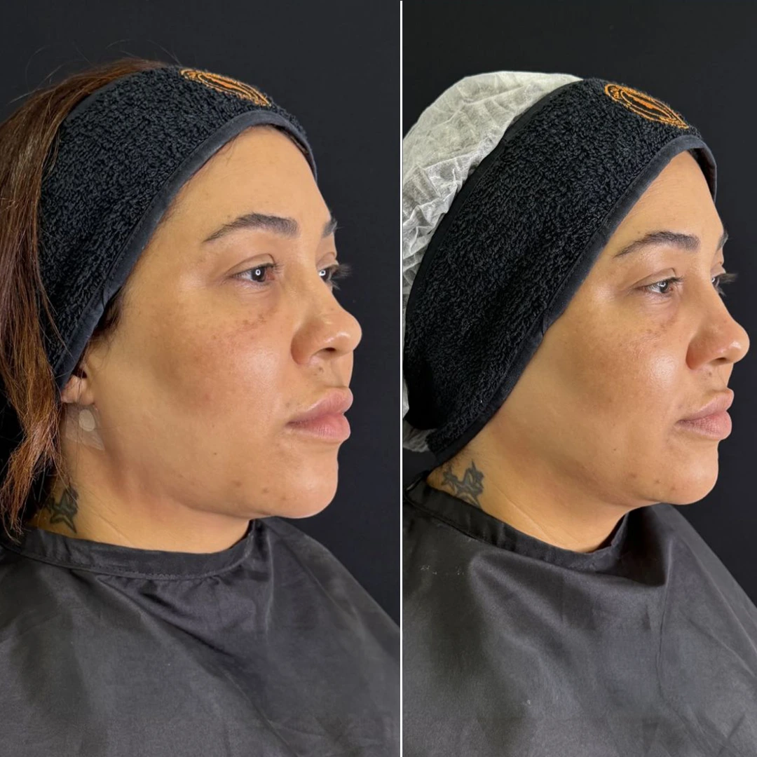 Antes e depois 3 - Dra. Amanda Syuffi